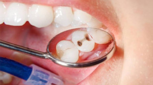نکاتی ساده برای جلوگیری از افتادن دندانها با افزایش سن
