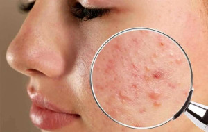 این روش های خانگی، قاتل جوش های چرکی و دردناک/ علت به وجود آمدن جوشهای سر سفید چیست؟