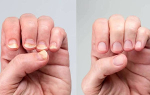 روش تشخیص کمخونی از روی ناخن و دست ؛ لکه های سفید روی ناخن ها نشانه کم خونی است ؟