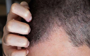 اگزمای پوست سر چیست و چطور درمان میشود؟