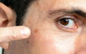 نشانههای اولیه سرطان پوست