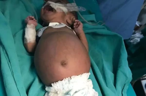 اتفاقی نادر در هند؛ تولد نوزادی که در شکمش جنین دوقلوی خود را داشت