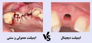 ایمپلنت دیجیتال و جایگزینی دندان با لیزر؛ نسل جدید درمان های دقیق و بدون درد جایگزینی دندان