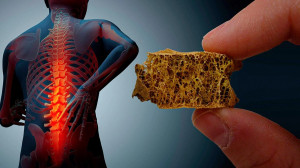 چگونه به پوکی استخوان مبتلا نشویم؟ | روش اصلی تشخیص پوکی استخوان